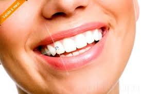 brillantini dentali-estetica dentale