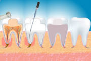 devitalizzazione dente-Endodonzia